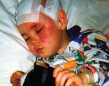 Sturge Weber syndrome explained